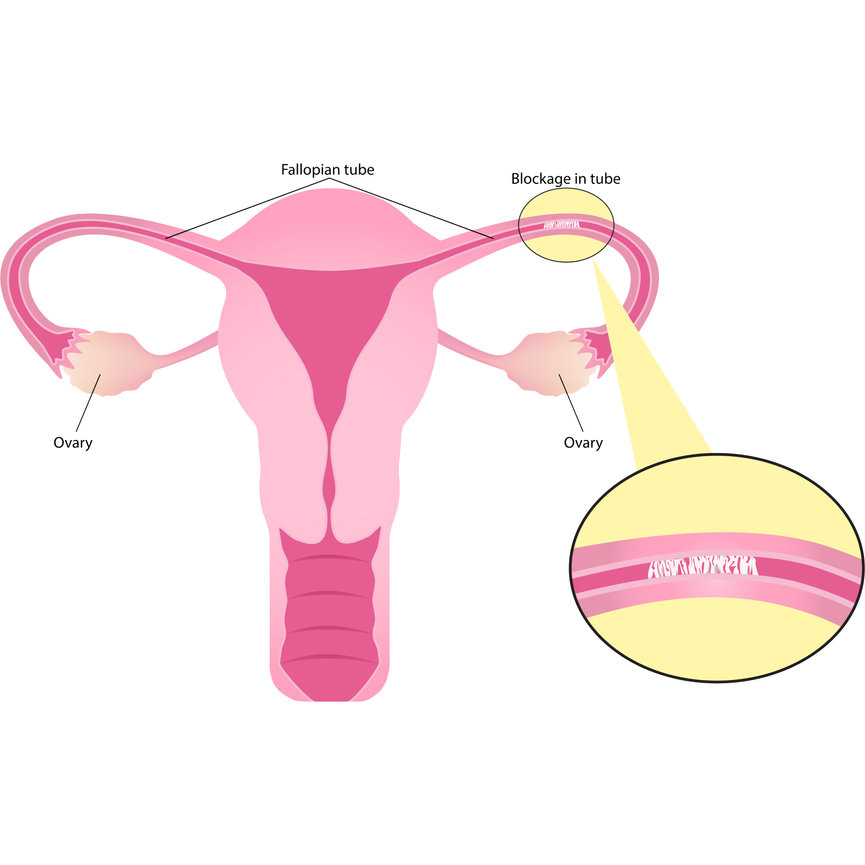 Fallopian Tube Disease Dr Joseph Leveno