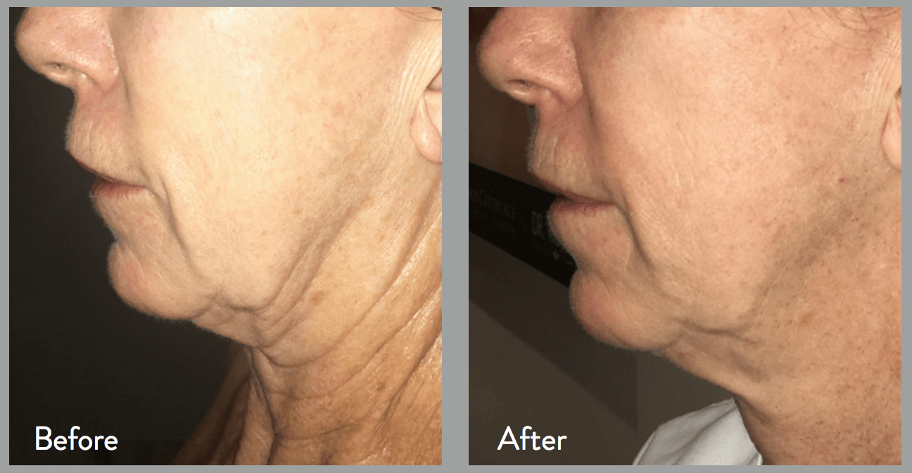 Morpheus8 Face & Body Contouring Feel Ideal 360 Southlake