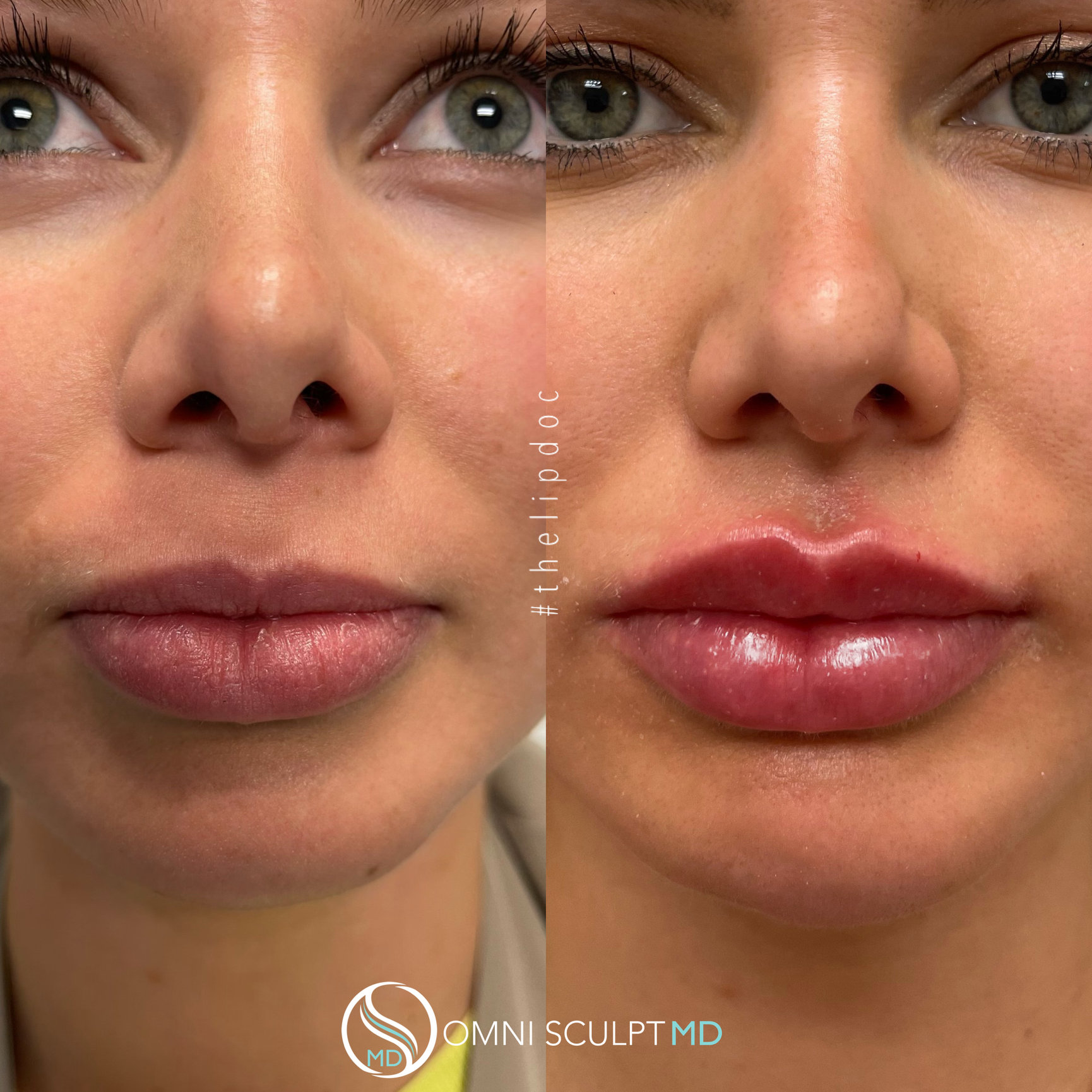 Lip Injections Before And Afters Omni Sculpt Md Dallas Texas 