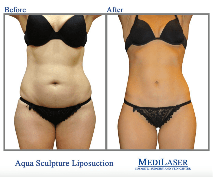 How To Perform Liposuction On Yourself