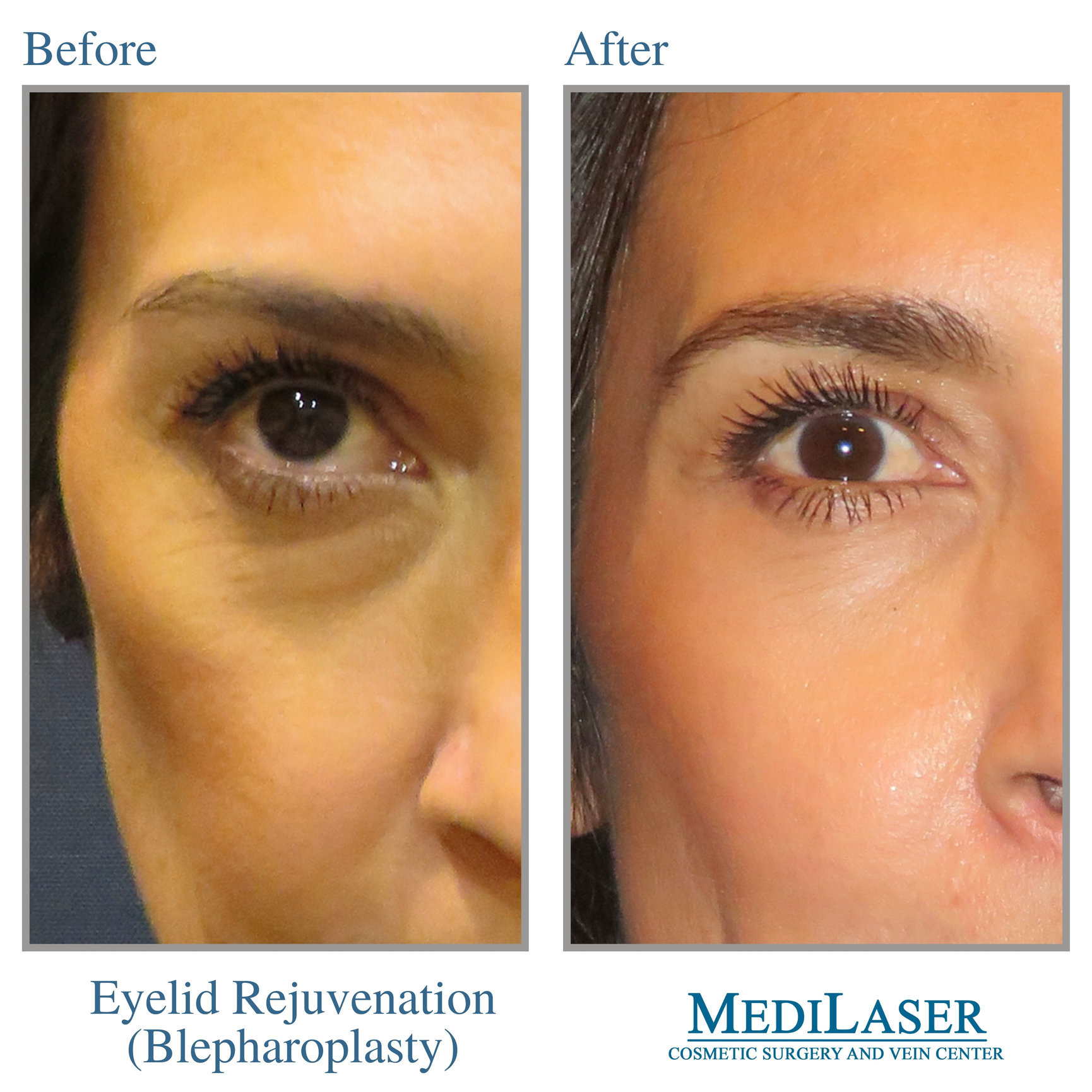 Eyelid Rejuvenation Blepharoplasty Before and After - Medilaser Surgery ...