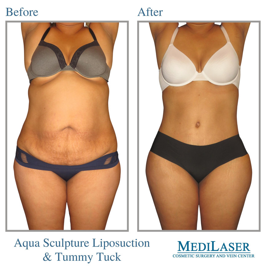 Tummy Tuck and Liposuction Before and After - Medilaser Surgery and Vein  Center
